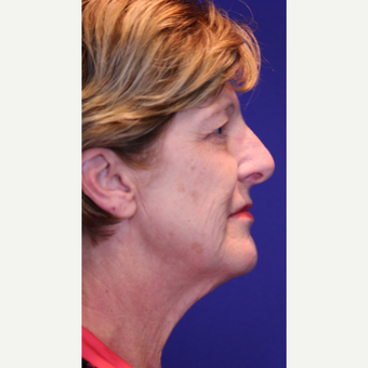 Facelift, Fractional CO2 Laser Skin Resurfacing before 3466440