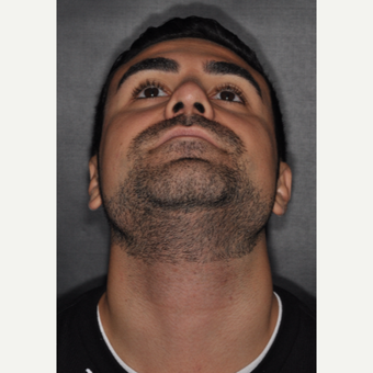 18-24 year old man treated with Nose Surgery 6 weeks post-op after 3500216