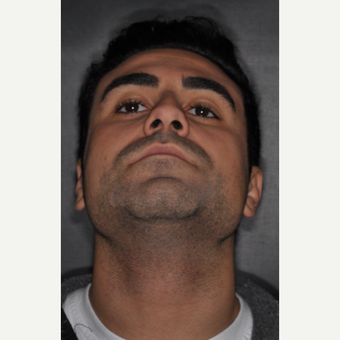 18-24 year old man treated with Nose Surgery 6 weeks post-op before 3500216