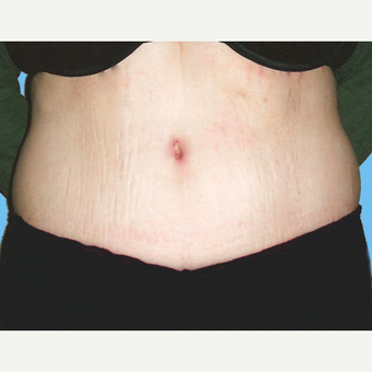 Tummy Tuck after 3813572