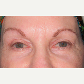 Eyelid Surgery (Blepharoplasty) after 3831536