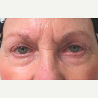 Eyelid Surgery (Blepharoplasty) before 3831536