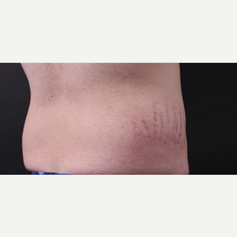 30 year old man treated with CoolSculpting before 3630353