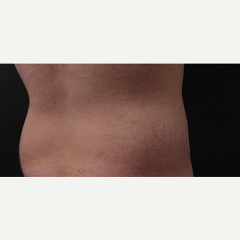 30 year old man treated with CoolSculpting after 3630353