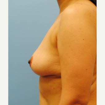 B to D cup. 430 cc ultra high profile silicone breast augmentation before 3422830