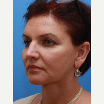 Woman treated with "Maintenance Facelift" after 3372808