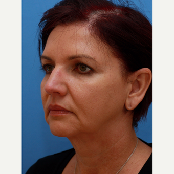 Woman treated with "Maintenance Facelift" before 3372808