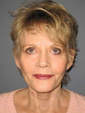 70 Year Old Minifacelift Patient after 1475061