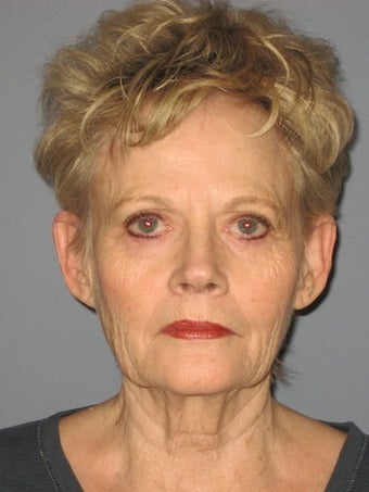 70 Year Old Minifacelift Patient before 1475061