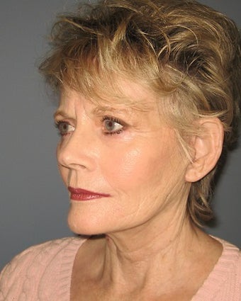 70 Year Old Minifacelift Patient 1475061
