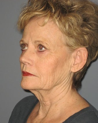 70 Year Old Minifacelift Patient 1475061