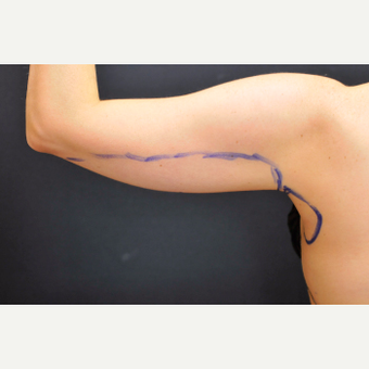 25-34 year old woman treated with Laser Liposuction to arms before 3781054