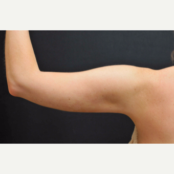 25-34 year old woman treated with Laser Liposuction to arms after 3781054