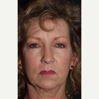 55-64 year old woman treated with Facelift before 3481264