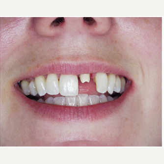45-54 year old woman treated with Dental Implants before 1995981