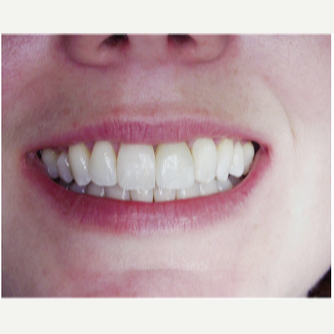 45-54 year old woman treated with Dental Implants after 1995981