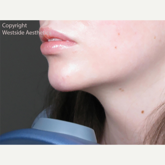 Juvederm Chin and Lip Enhancement after 2972534