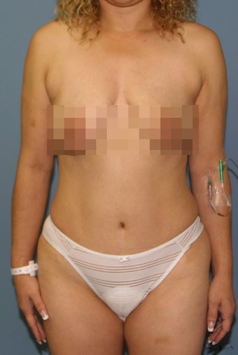 18-24 year old woman treated with Tummy Tuck Revision after 3512574