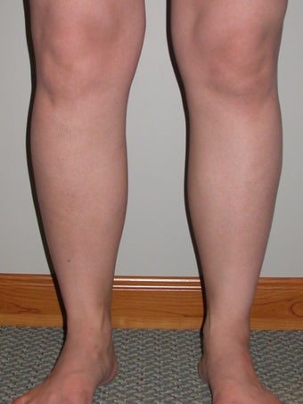 Liposuction of ankles and calves before 295531