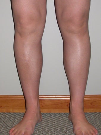 Liposuction of ankles and calves after 295531