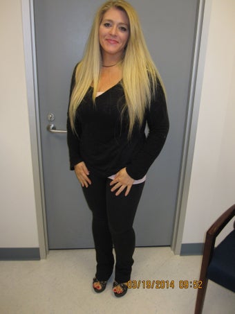 Sleeve Gastrectomy Before & After after 1275804