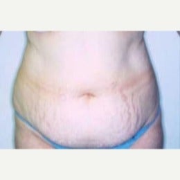 48 year old female patient before 1826707
