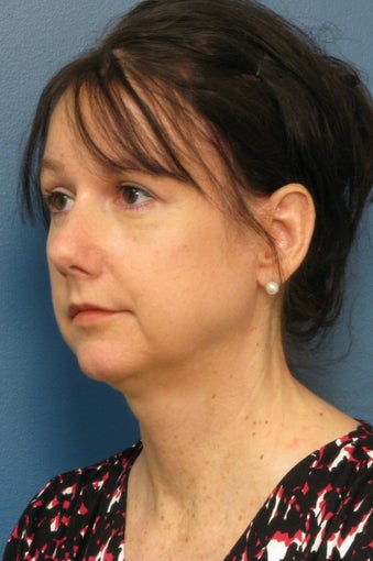 Brow Lift, Upper & Lower Eyelid Surgery 338739