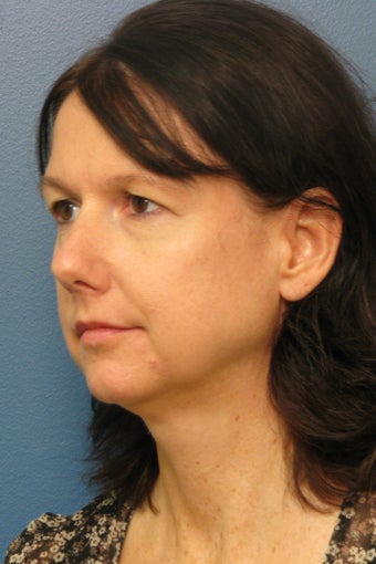Brow Lift, Upper & Lower Eyelid Surgery 338739
