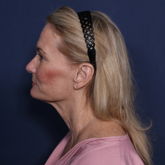 55-64 year old woman treated with Neck Lift (view 2 of 2) before 3175377