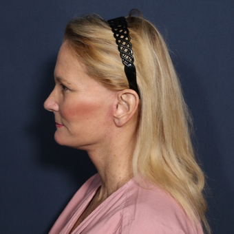 55-64 year old woman treated with Neck Lift (view 2 of 2) after 3175377