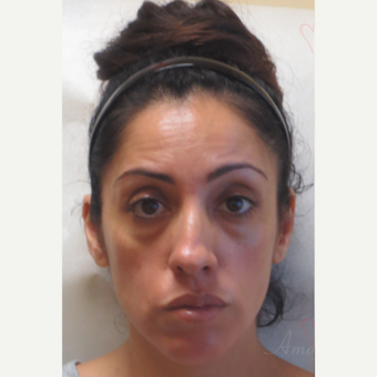 35-44 year old woman treated with Voluma in the cheeks before 3381416