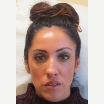 35-44 year old woman treated with Voluma in the cheeks after 3381416