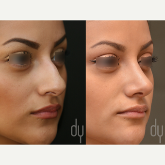 Primary Open Rhinoplasty and Septoplasty before 3322582