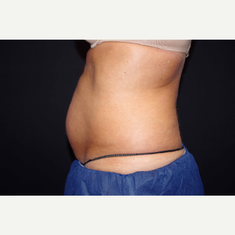 55-64 year old woman treated with CoolSculpting before 2966370