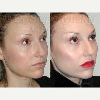 25-34 year old woman treated with Cheek Augmentation using Radiesse after 2341896