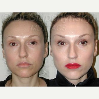 25-34 year old woman treated with Cheek Augmentation using Radiesse before 2341896