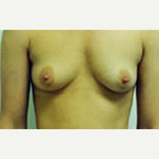 18-24 year old woman treated with Breast Augmentation before 3788596