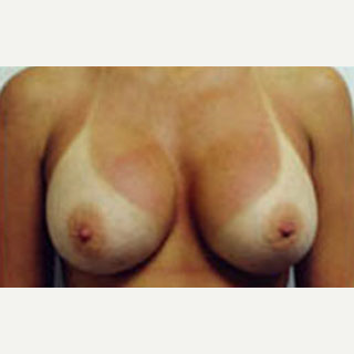 18-24 year old woman treated with Breast Augmentation after 3788596