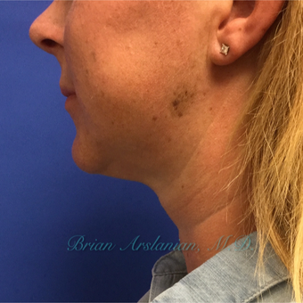 35-44 year old woman treated with Kybella for double chin reduction after 3151946