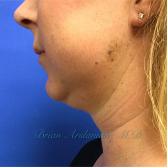 35-44 year old woman treated with Kybella for double chin reduction before 3151946