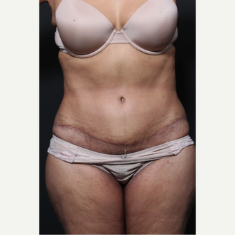 65-74 year old woman treated with Tummy Tuck 1659783