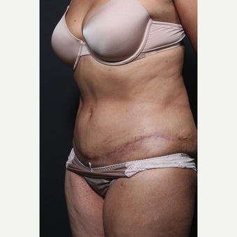 65-74 year old woman treated with Tummy Tuck after 1659783