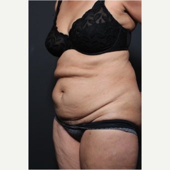 65-74 year old woman treated with Tummy Tuck before 1659783