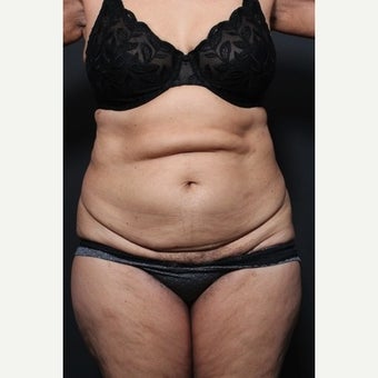 65-74 year old woman treated with Tummy Tuck 1659783