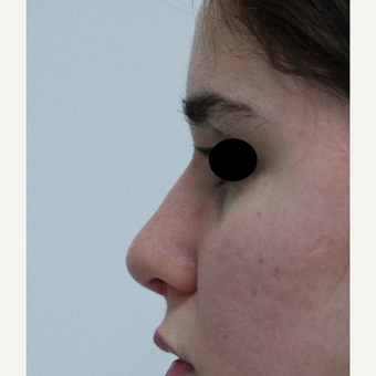 18-24 year old woman treated with Rhinoplasty after 3638032