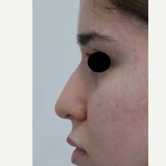 18-24 year old woman treated with Rhinoplasty before 3638032