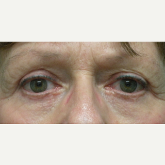 55-64 year old woman treated with Eyelid Surgery after 3802372
