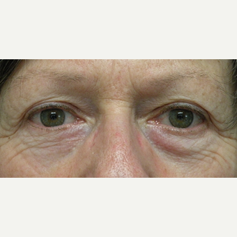 55-64 year old woman treated with Eyelid Surgery before 3802372