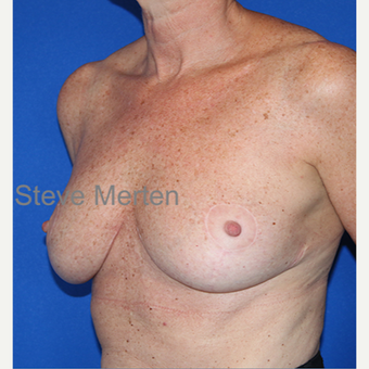 45-54 year old woman treated with Breast Reduction after 3432327