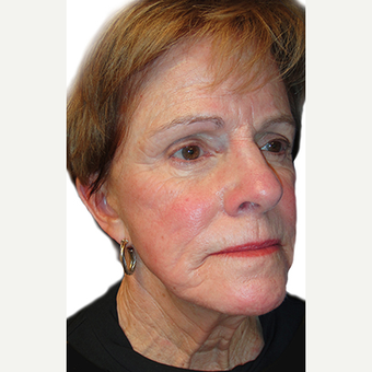 60 year old woman treated with Fat Transfer before 3409042